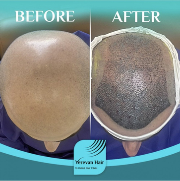 Slider image (7) United Hair Clinic